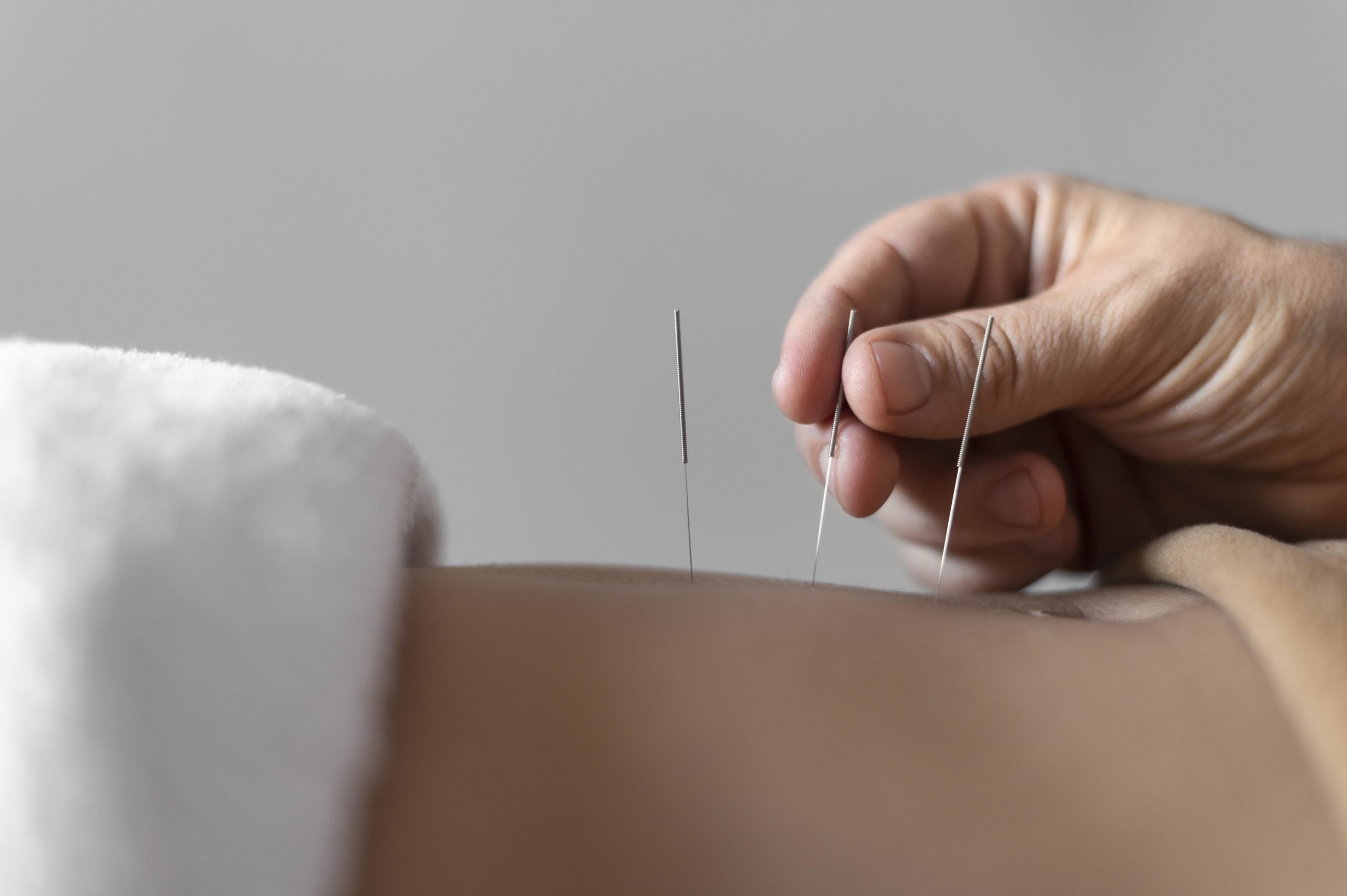 Aplicación de la acupunta curativa sobre la espalda de un paciente