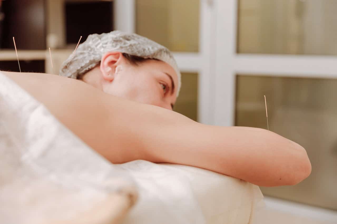 mujer se relaja en su sesión de acupuntura para adelgazar